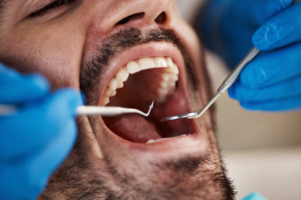 Best Emergency Dental Extractions in Montgomery Village, MD